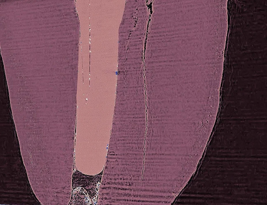 A section along a treated root canal (filling in pink) reveals dentine cracks by phase contrast-enhanced μCT. Credit: P. Zaslansky
