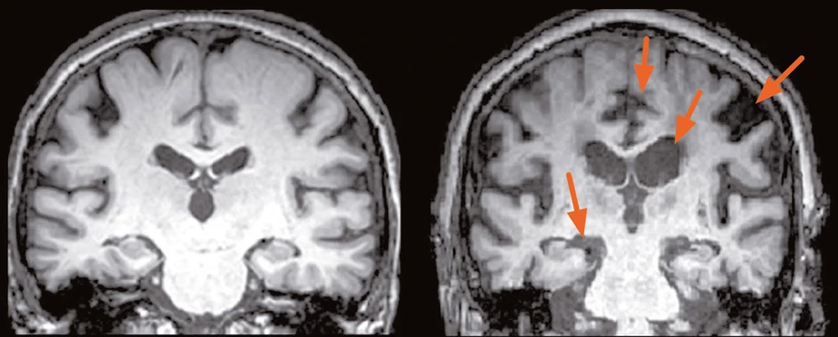 Hirnsubstanz von zwei gleichaltrigen Menschen (ca. 70 Jahre alt): Links ein Gesunder und rechts ein Patient mit beginnender Alzheimer-Erkrankung