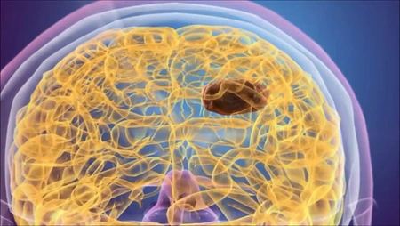 Schematische Darstellung eines Hirntumors. Quelle: Youtube-Video MagForce AG. Quelle: Youtube-Video MagForce AG